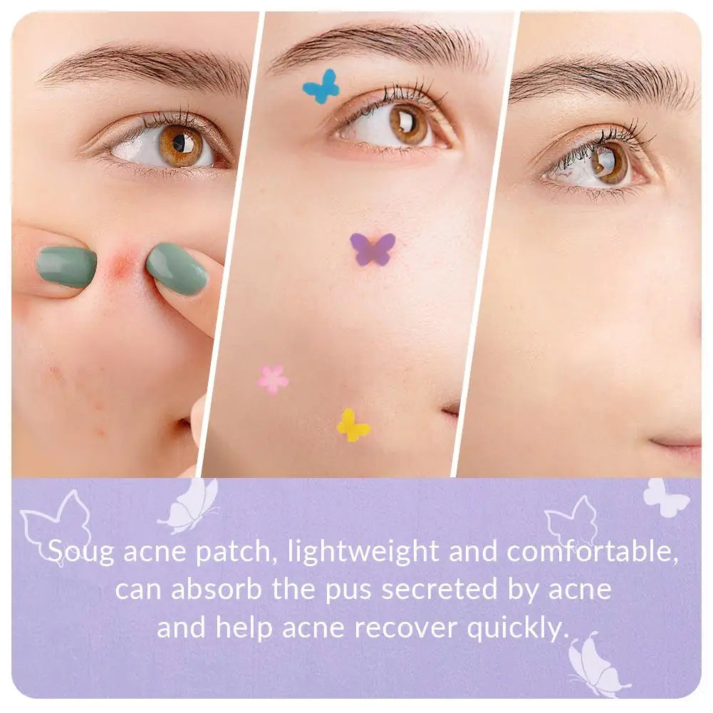 PATCHS ANTI-ACNE BUTTERFLY, AUTOCOLLANTS INVISIBLE